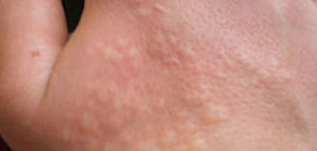 nettle sting on hand